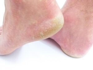 cornea, skin, foot, sole of the foot, heel, walking barefoot, foot care, mushroom, human, pain, body, barefoot, athlete's foot, sole, relax, cracked, close up, white background, man, health, medicine, foot care, foot care, foot care, foot care, foot care, athlete's foot, athlete's foot, athlete's foot, athlete's foot Cracked Heels No More: रातभर में असर दिखेगा! देसी घी से करें एड़ियों का कायाकल्प